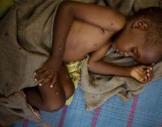 救助索马里饥荒儿童